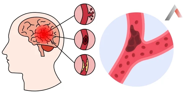 İskemik İnme Nedir?